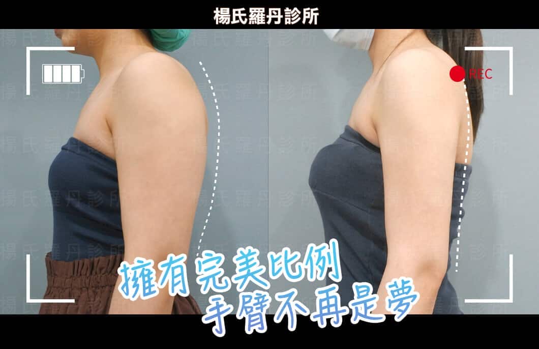 【雷射減脂】跟贅肉掰掰~擁有完美比例手臂不再是夢!